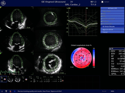 Image: A dilated heart shown with 4D strain (photo courtesy Business Wire).